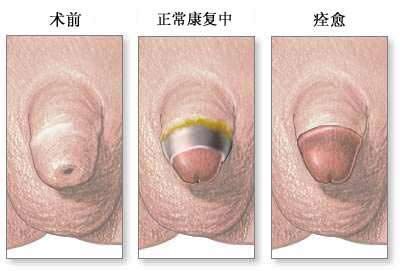 男性包皮手术后如何做好自我保养